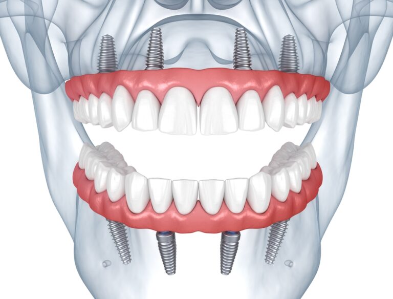 All-on-4®: is it Right for You?