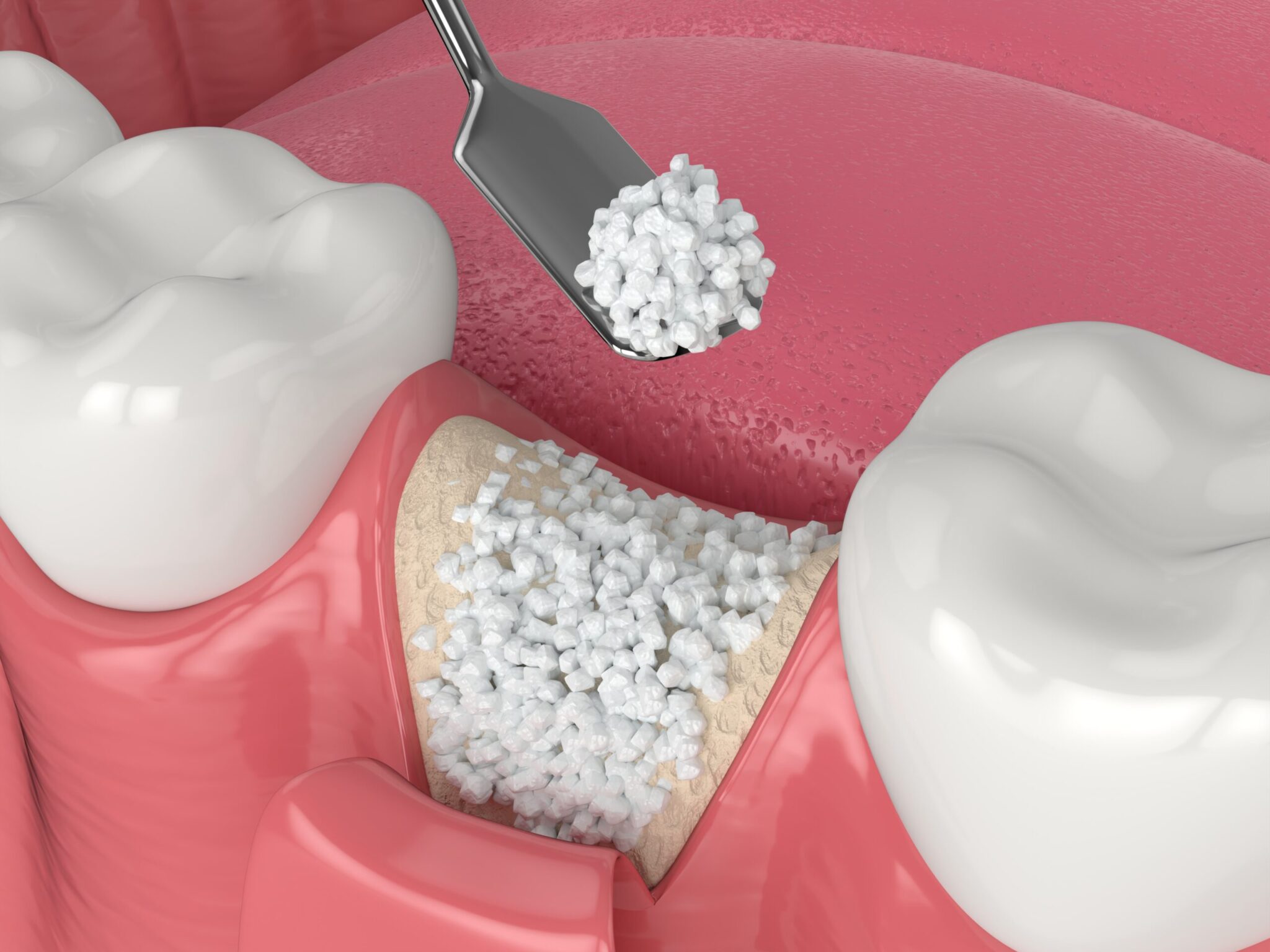 Implant Dentistry in Glendale, AZ | Smile Science Dental Spa 25 3D Rendering of Allograft Ridge Preservation