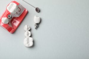 Implant Dentistry in Glendale, AZ | Smile Science Dental Spa 32 Dental implant and bridge next to model