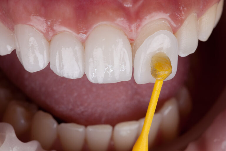 Dental Veneers: The Pros, Cons, and Surprising Realities