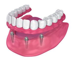 Implant Overdenture 3D Rendering
