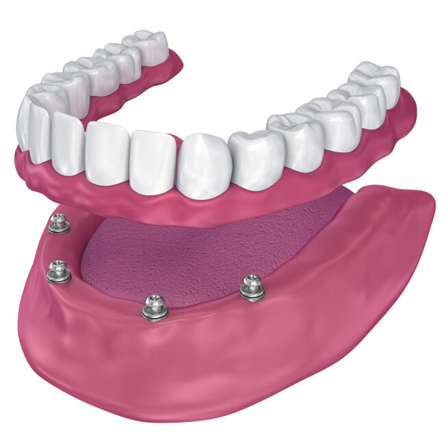Snap-in Implant Overdenture