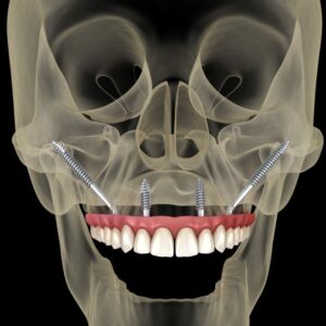 Zygoma Implants with Implant-Supported Fixed Maxillary Prosthesis