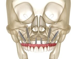 Implant Dentistry in Glendale, AZ | Smile Science Dental Spa 28 Zygoma implants and maxillary prosthesis