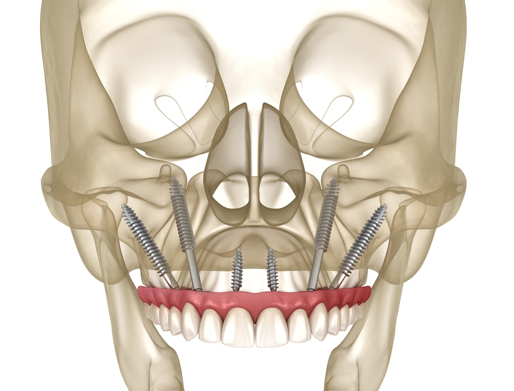 Zygoma implants and maxillary prosthesis