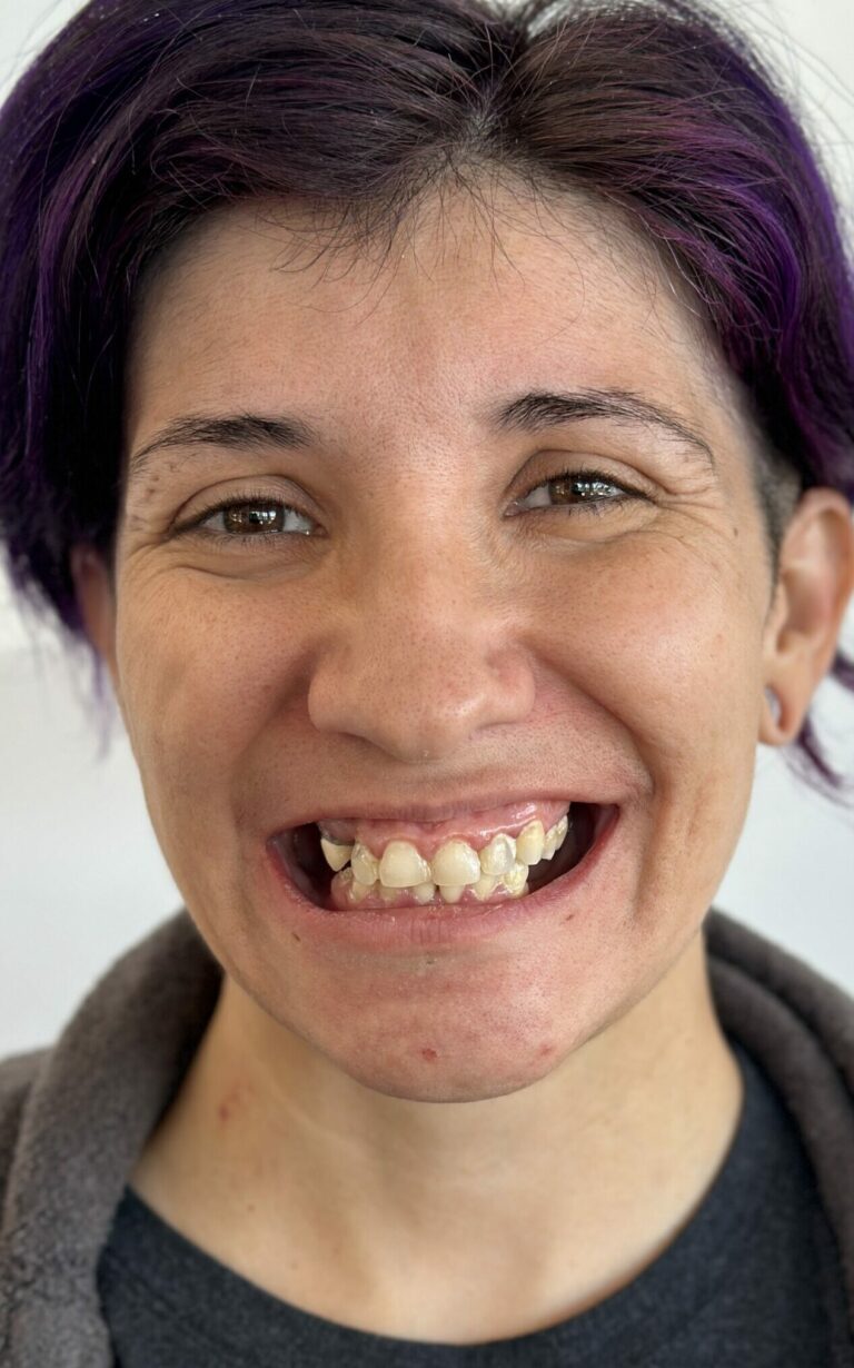 All-on-4® Implant Dentures in Glendale, AZ 1 Before