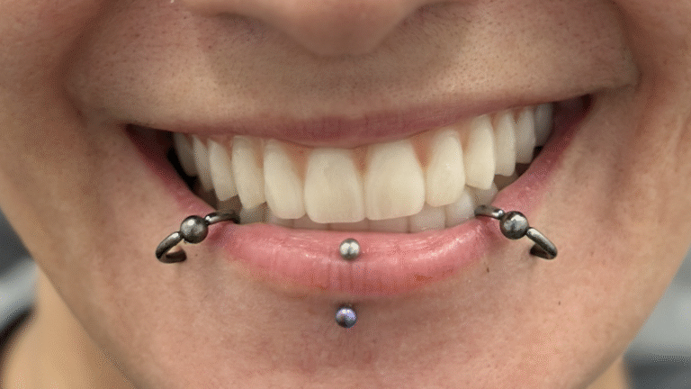 All-on-4® Implant Dentures in Glendale, AZ 5 After