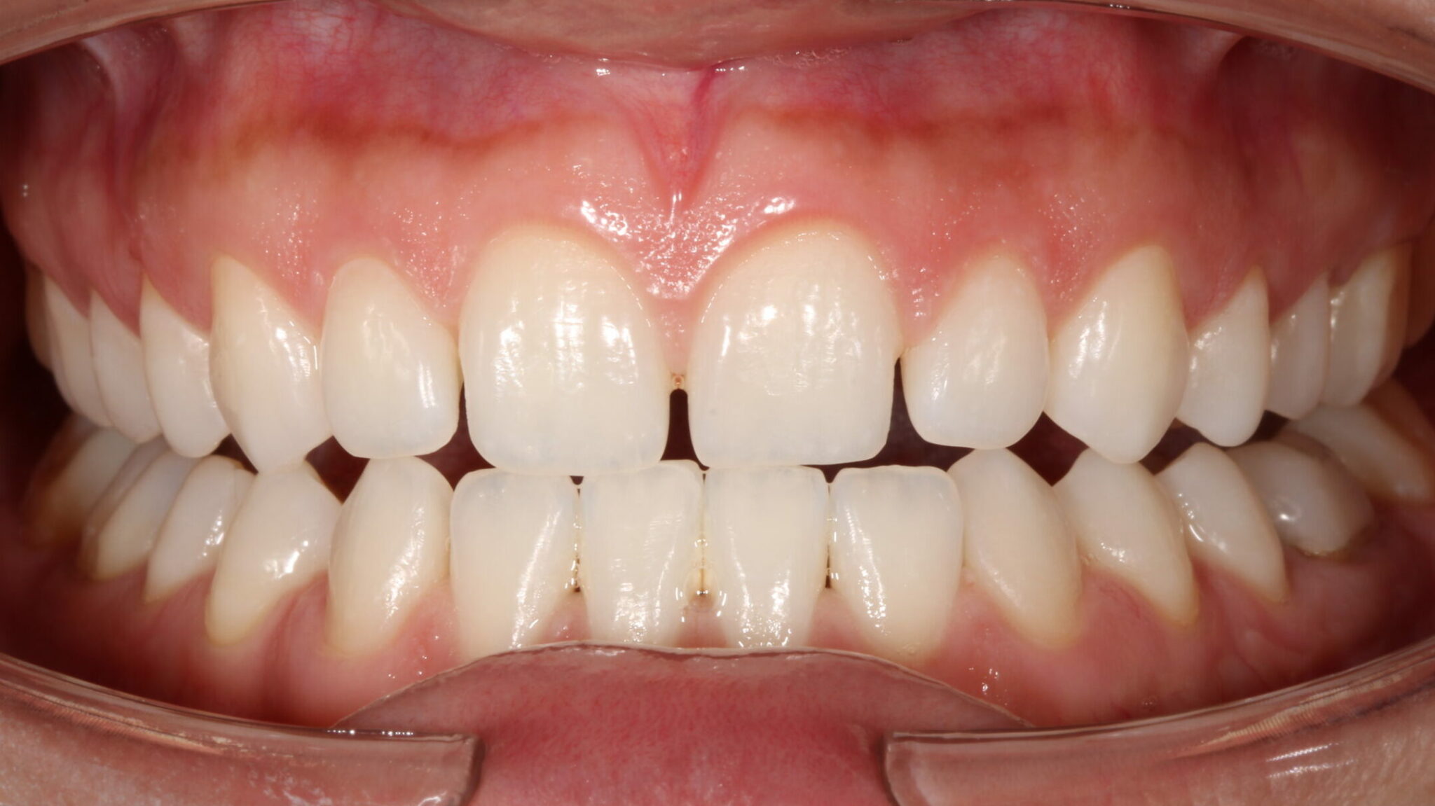 Before cosmetic veneers