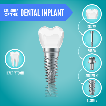 Implant Infographic