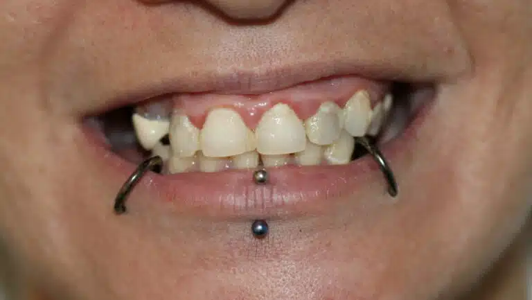 All-on-4® Implant Dentures in Glendale, AZ 4 Before