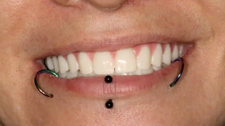 All-on-4® Implant Dentures in Glendale, AZ 5 After