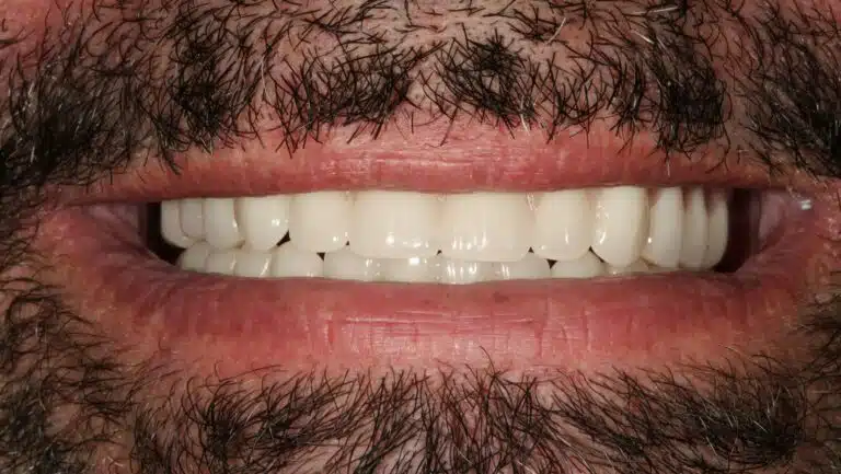 All-on-4® Implant Dentures in Glendale, AZ 9 After