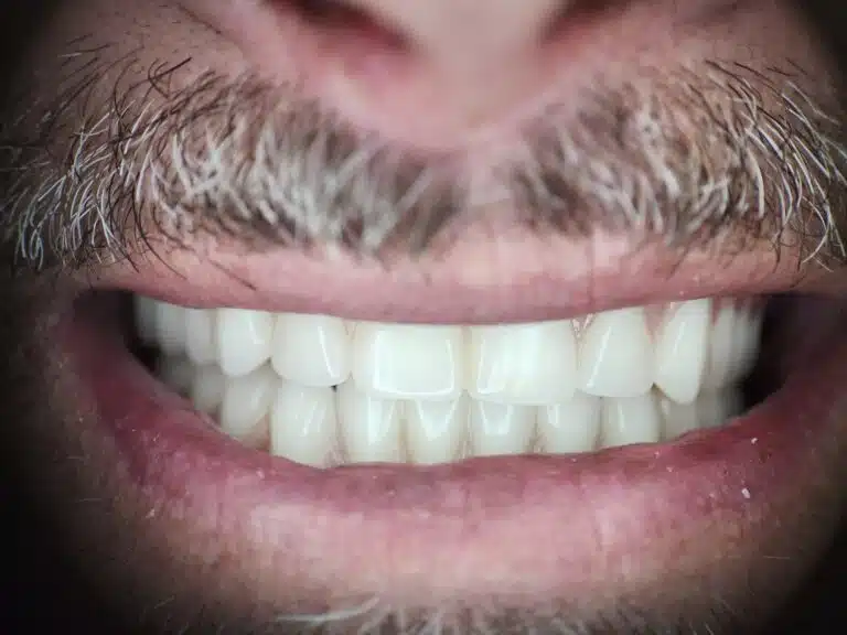 All-on-4® Implant Dentures in Glendale, AZ 7 After