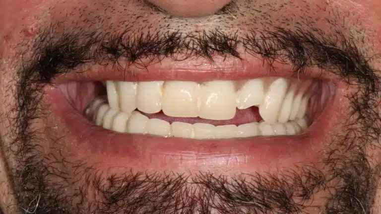 All-on-4® Implant Dentures in Glendale, AZ 8 Before