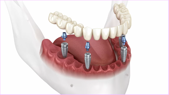 All-on-4® Implant Dentures in Glendale, AZ 12 3D rendering of all-on-4 FP1 prosthesis