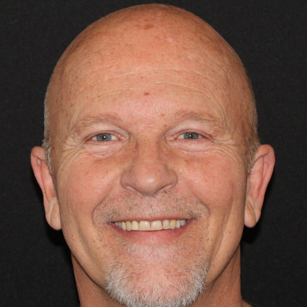 Implant Dentistry in Glendale, AZ | Smile Science Dental Spa 15 Before