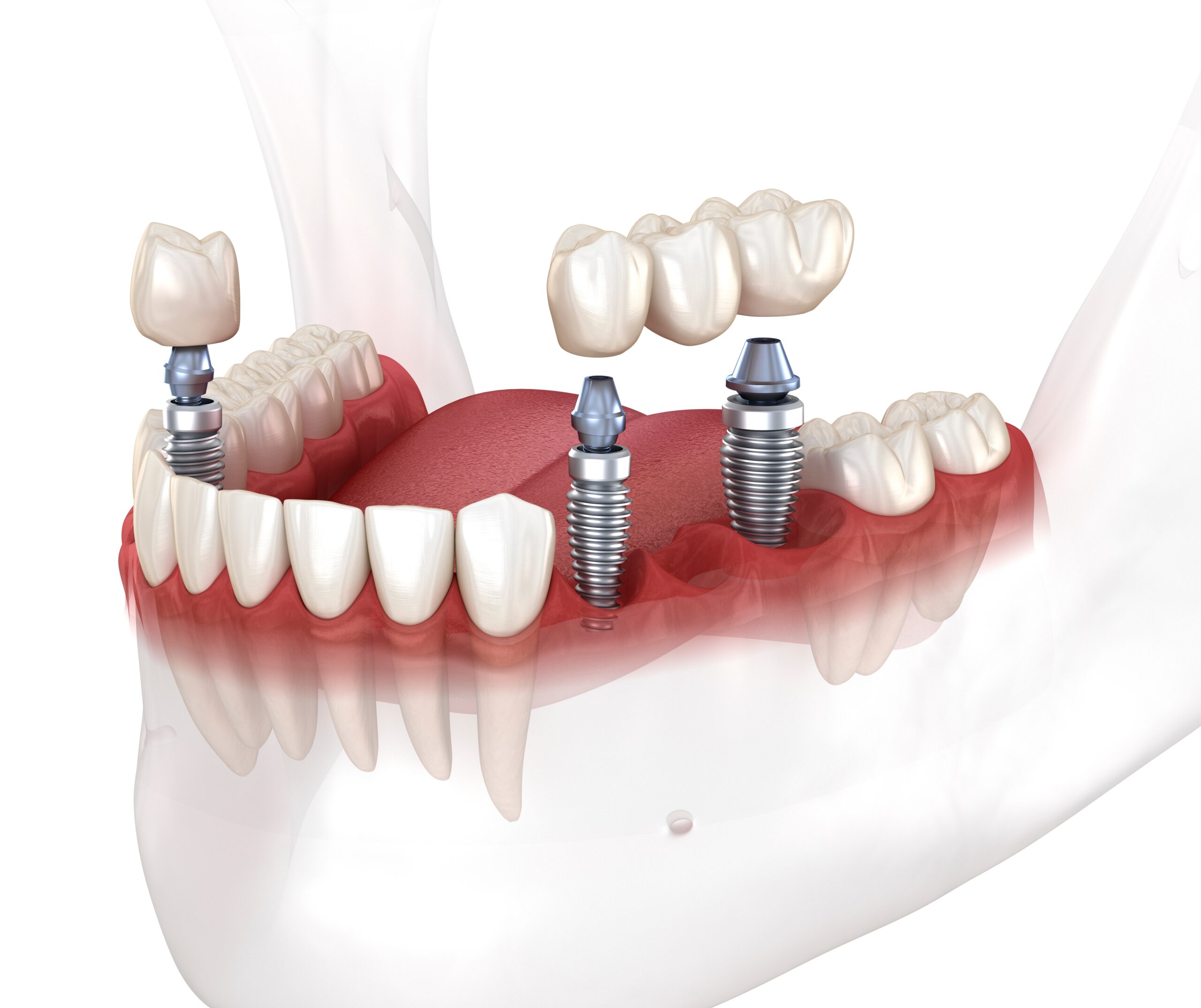 Implant Dentistry in Glendale, AZ | Smile Science Dental Spa 20 3D Rendering of Single-Unit and 3-Unit Implants with Prostheses