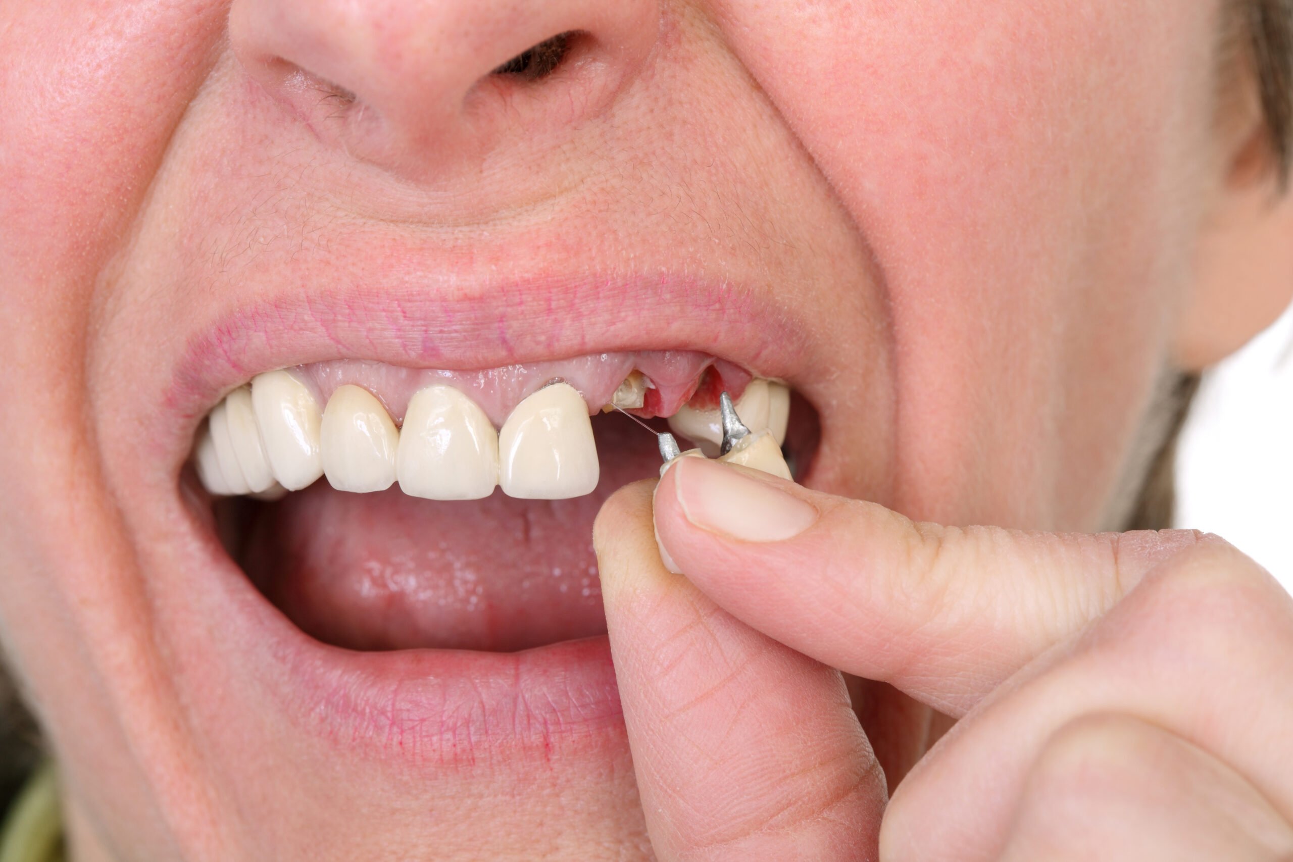 Dental Implants in Glendale, AZ 5 A person inserts a failed bridge into their mouth.