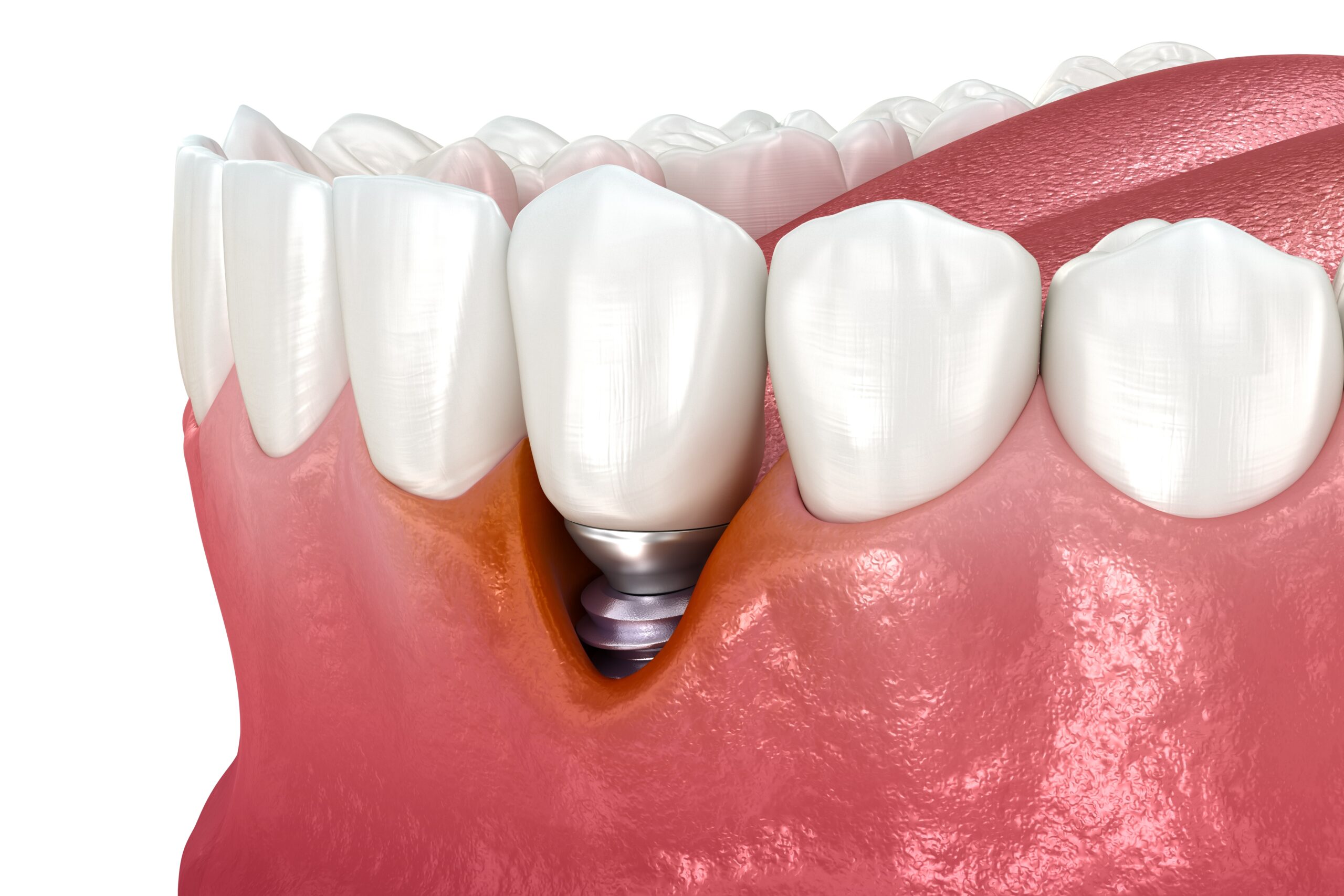 Implant Dentistry in Glendale, AZ | Smile Science Dental Spa 24 Peri-Implantitis Treatment