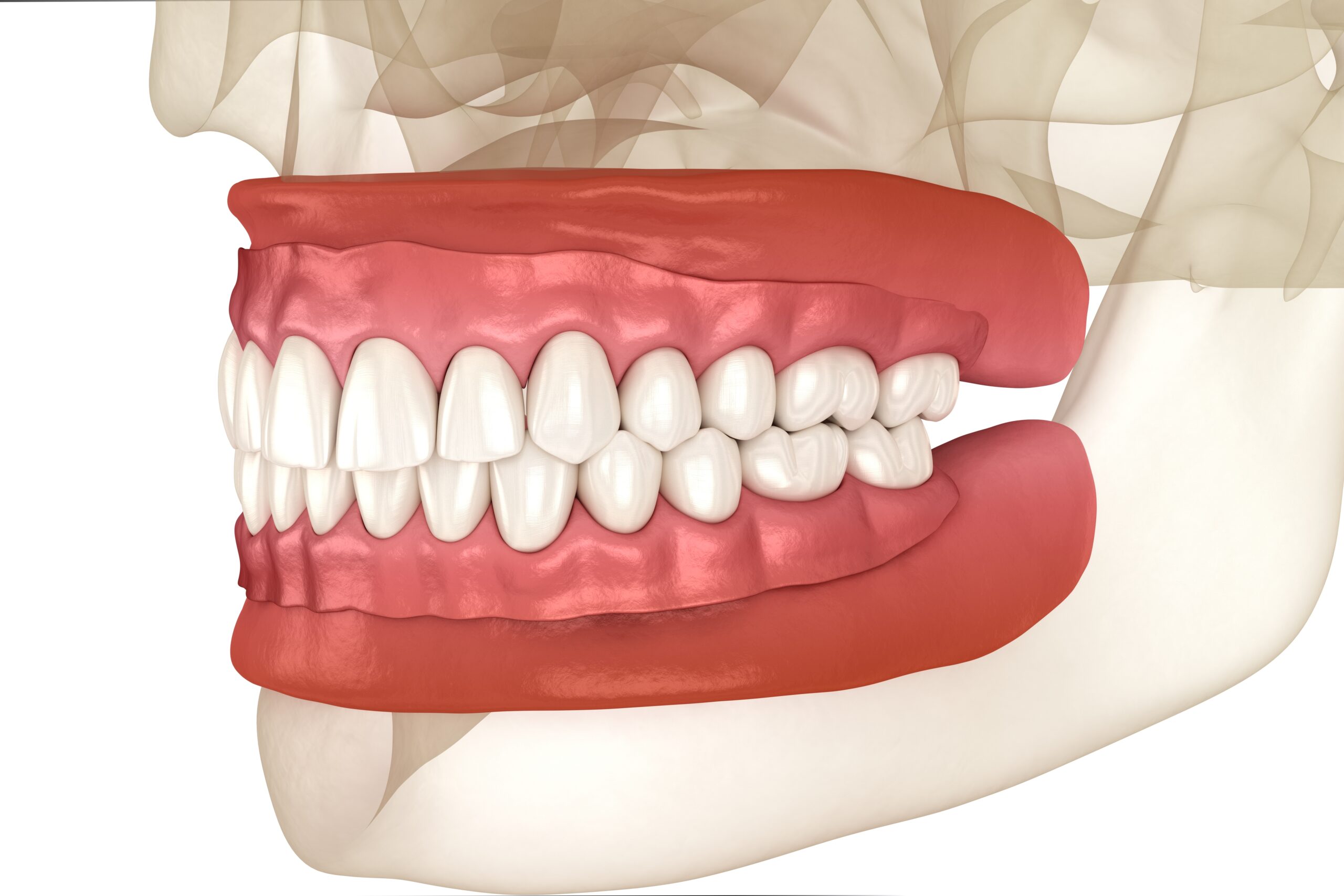 Implant Dentistry in Glendale, AZ | Smile Science Dental Spa 23 3D Rendering of Upper & Lower Traditional Complete Dentures on Skull