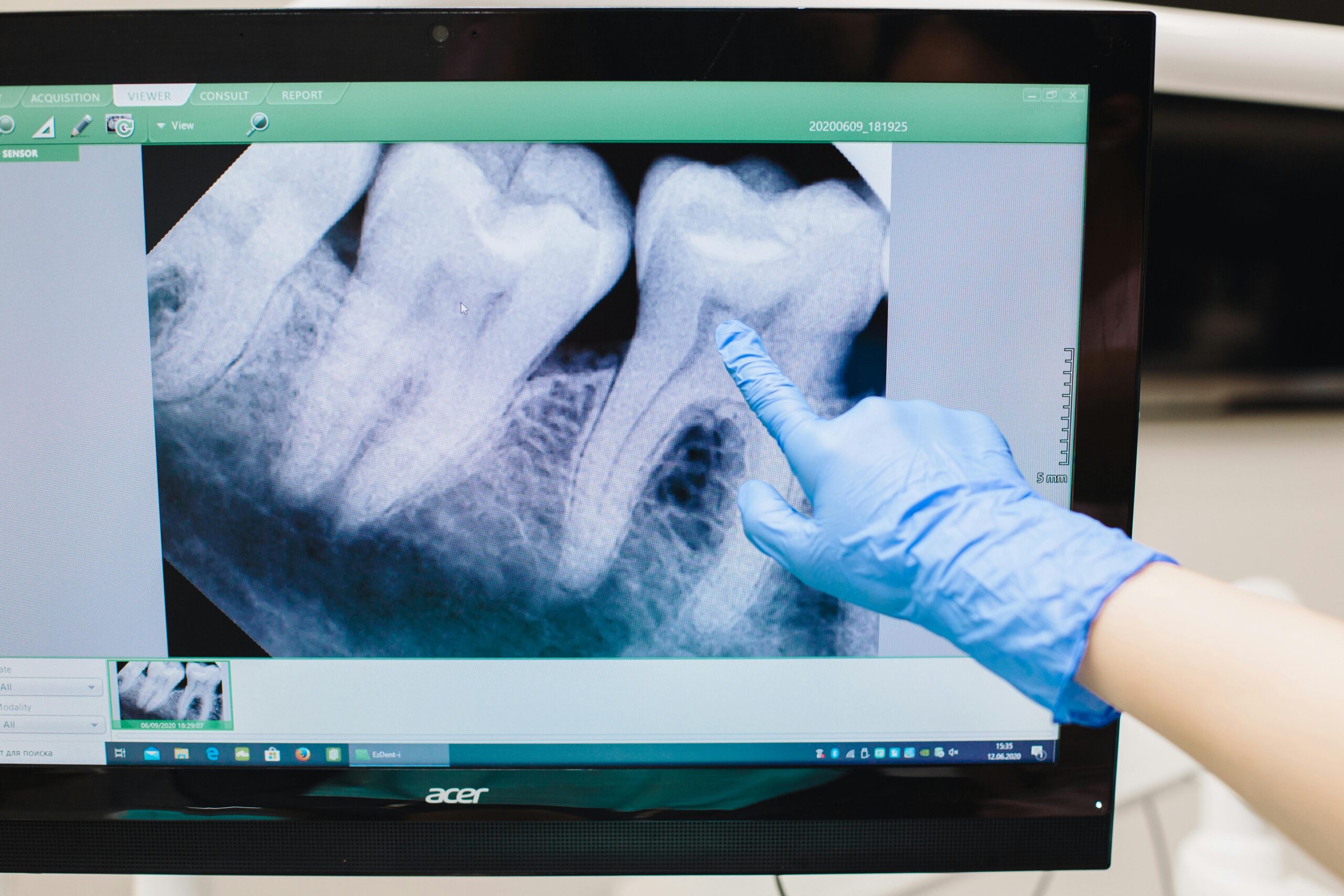 Gloved hand pointing at dental X-ray on a computer screen.