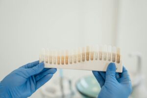 Gloved hands holding a tooth shade guide for composite bonding.