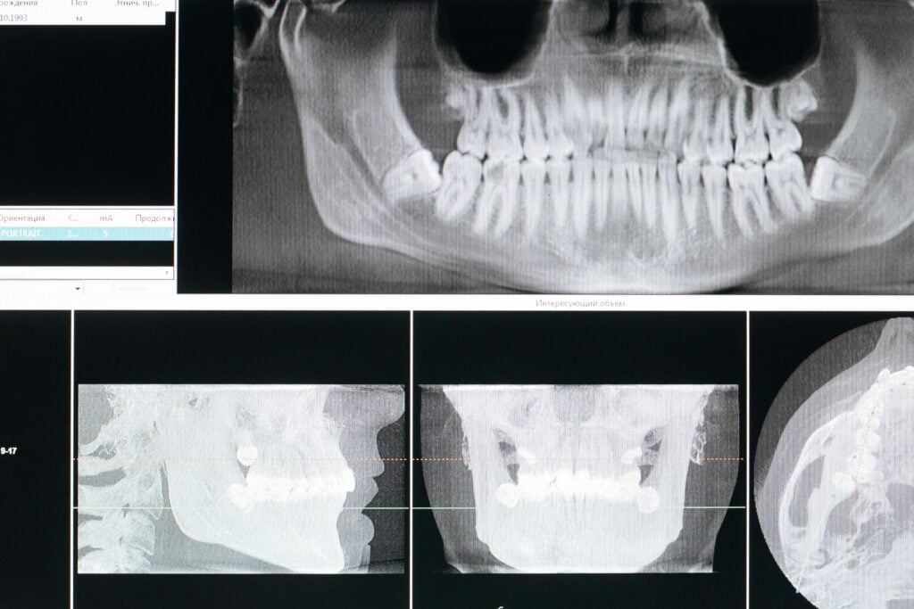 X-ray images showing jaw and teeth, relevant to TMJ disorder.