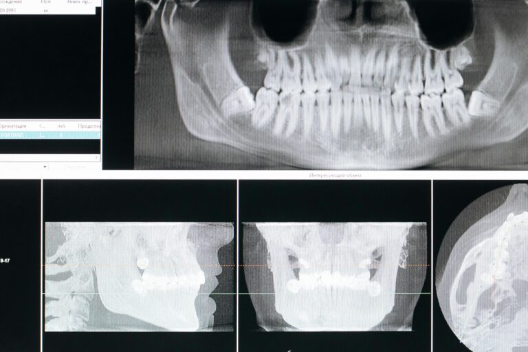 TMJ Disorder: Causes & Treatments