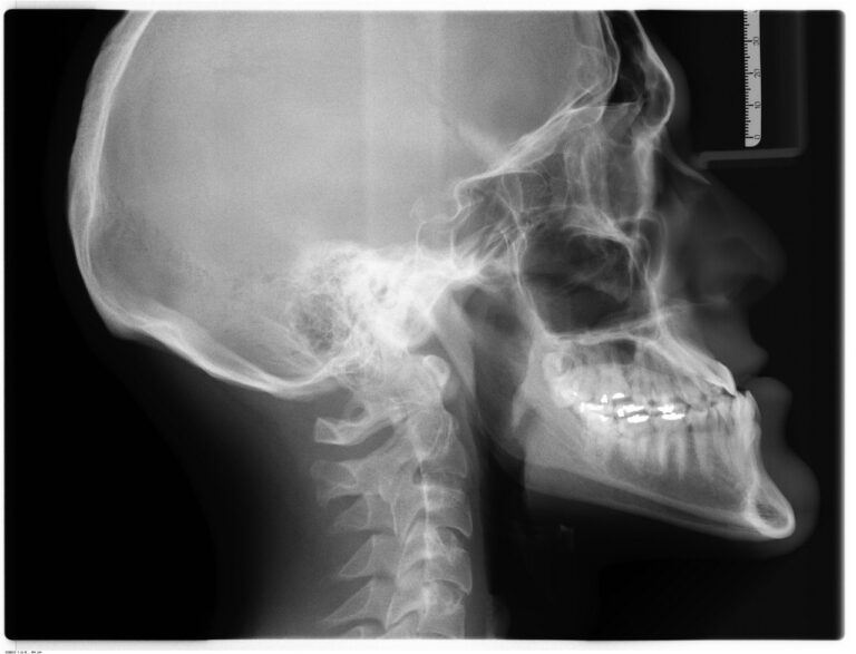 Dental X-Rays: Purpose & Safety