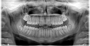 Implant Dentistry in Glendale, AZ | Smile Science Dental Spa 29 Dental X-ray showing full set of teeth, relevant to Scottsdale dental implants.