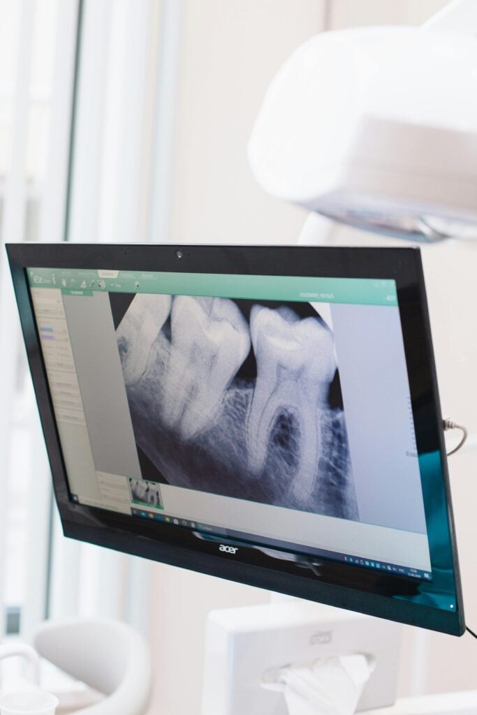 Dental X-ray showing wisdom teeth on a monitor.