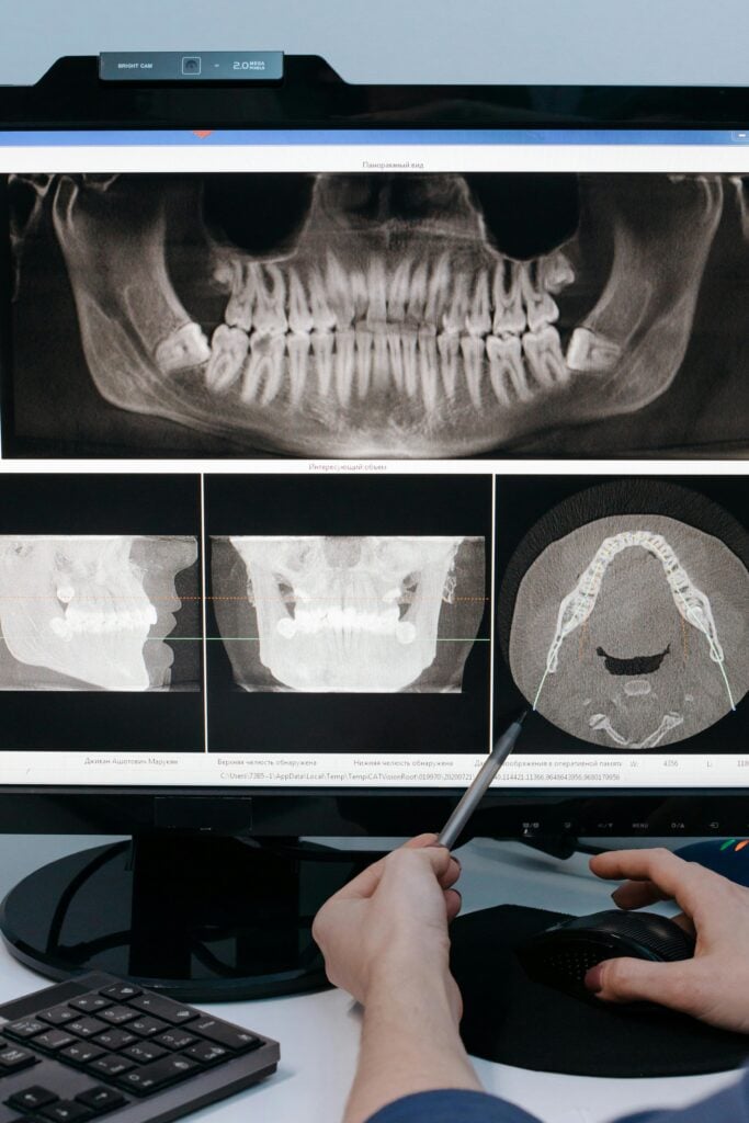 Dental X-rays displayed on a computer screen.
