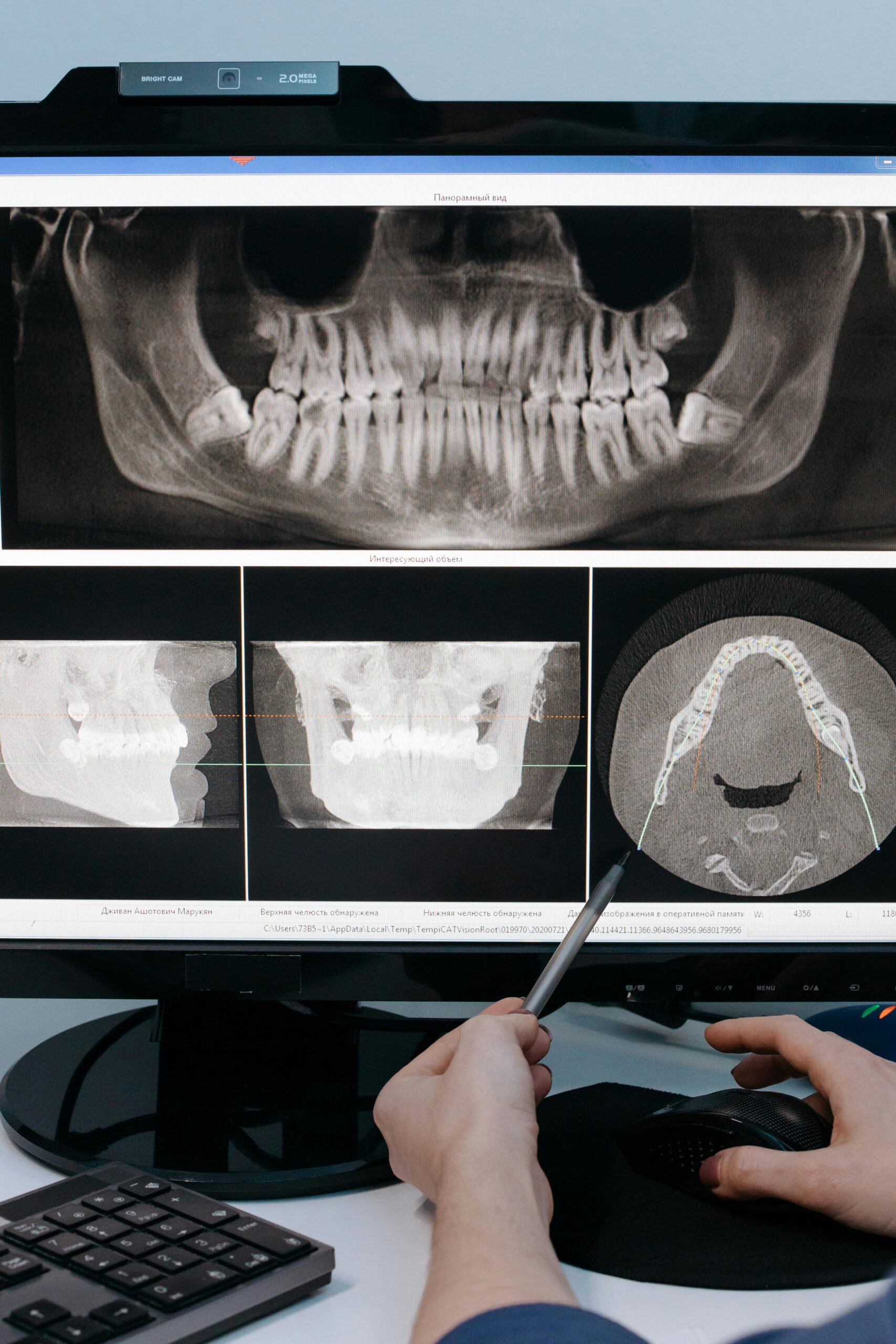 Dental X-rays displayed on a computer screen.