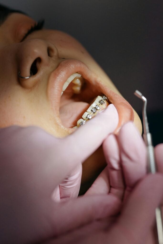 Dentist adjusting braces on a child's teeth.