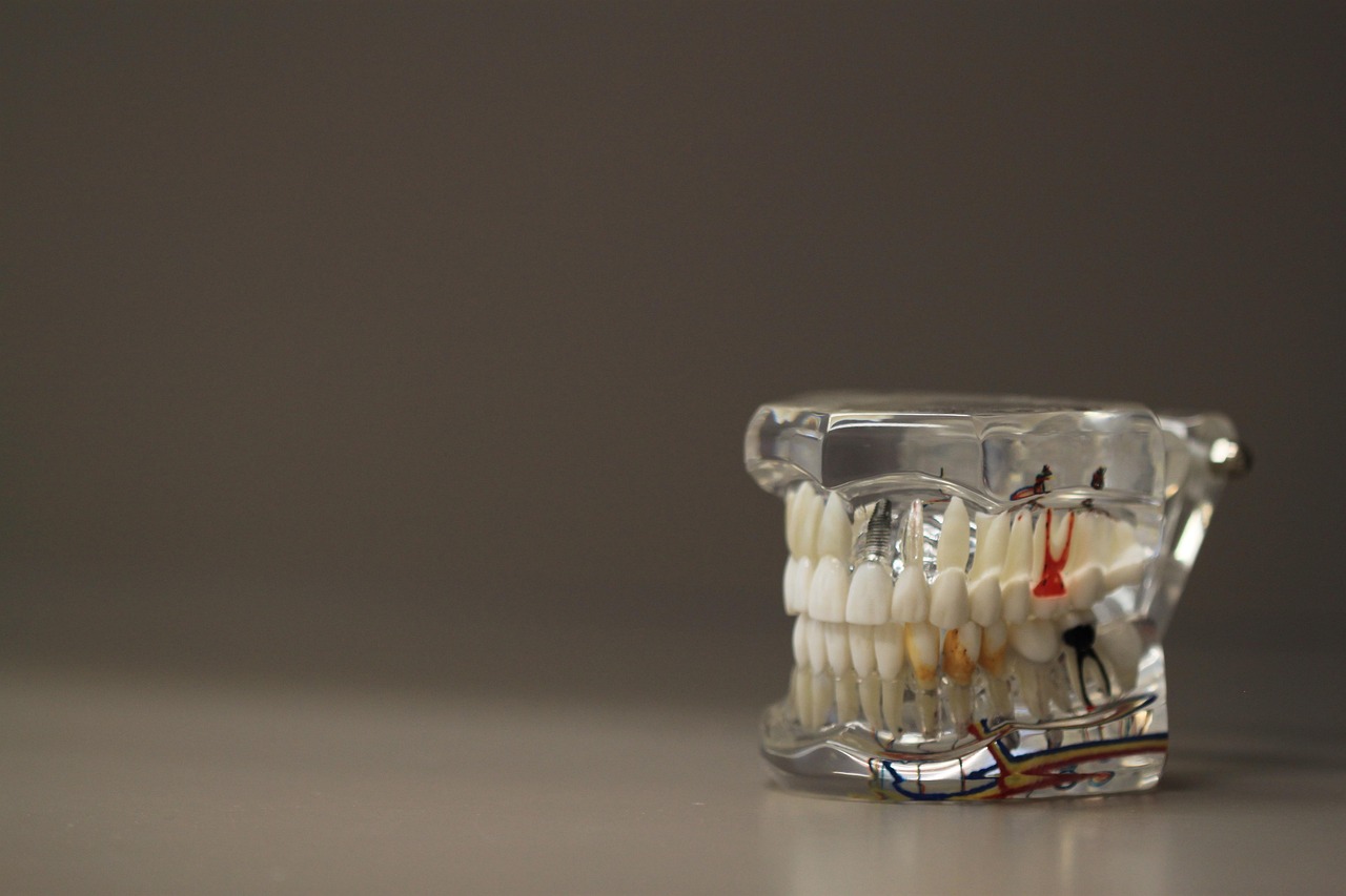 Dental model showing tooth replacement options with implants.