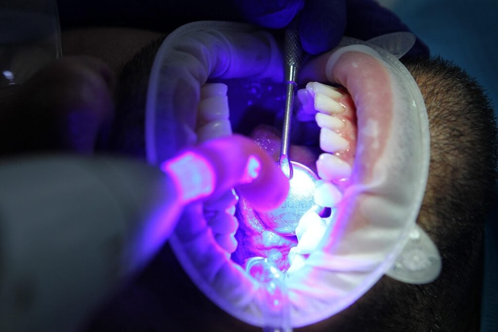 Dental procedure with blue light in patient's mouth.