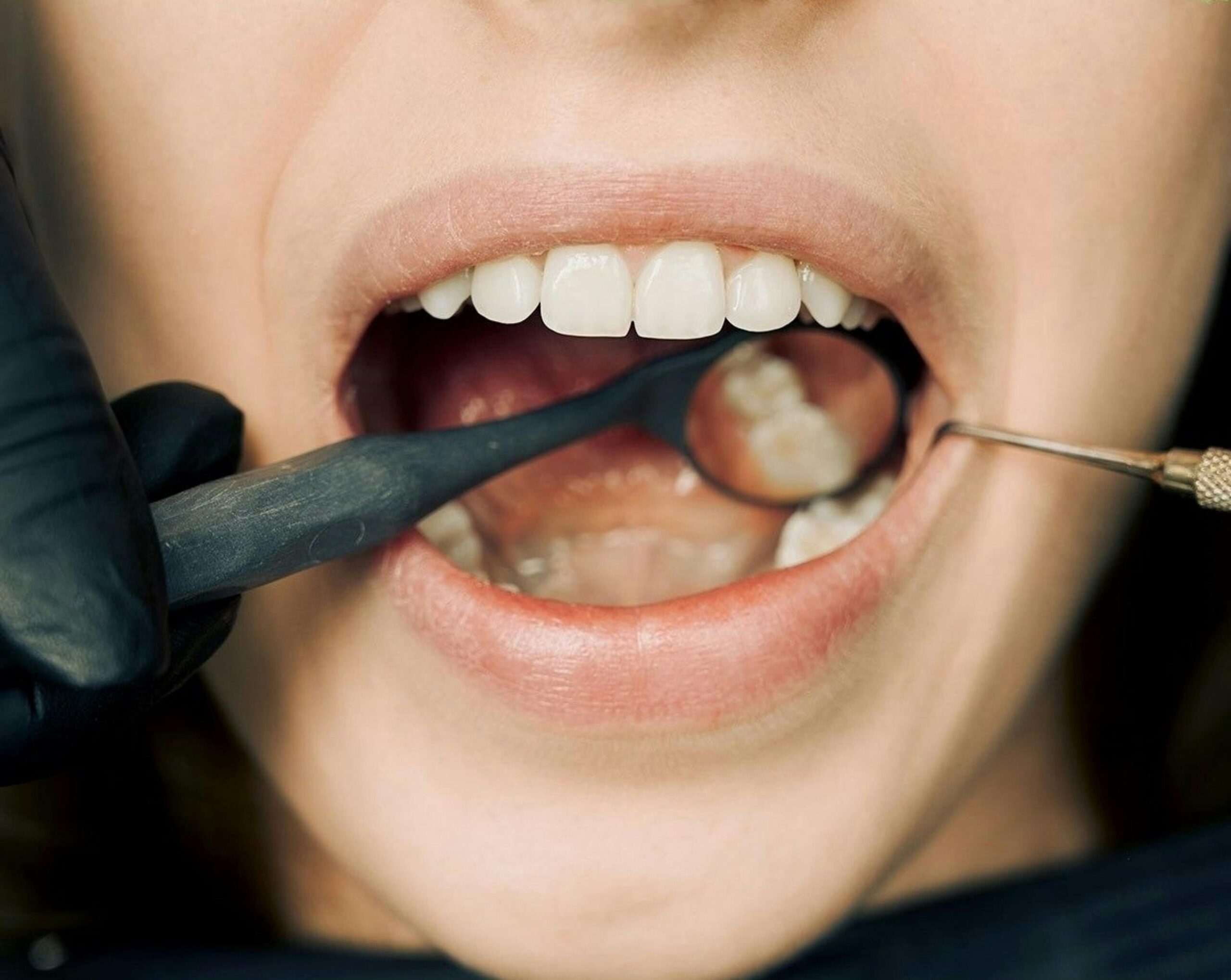 Close-up of a dental examination with tools for plaque removal.