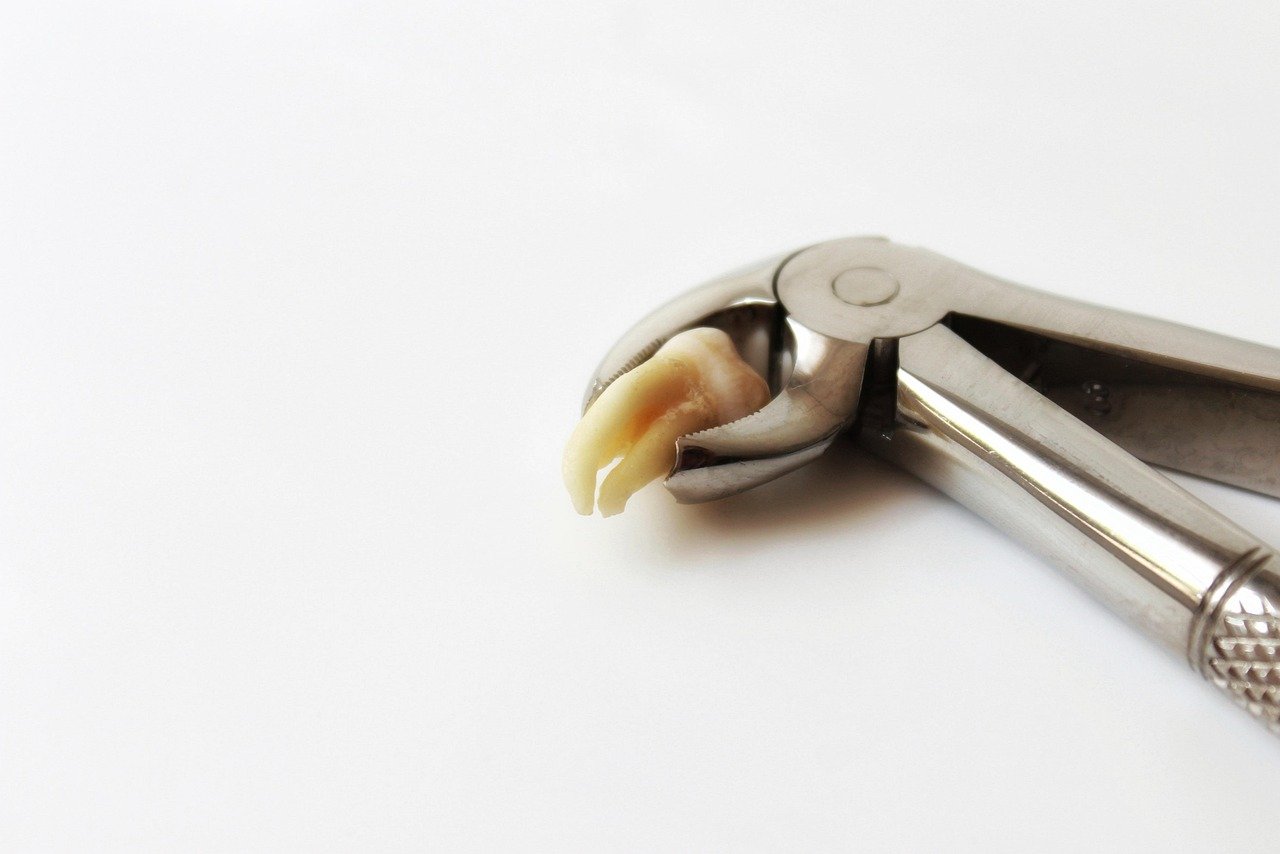 Extracted tooth held by dental forceps on white background.