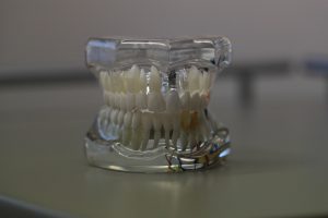 Dental model showing tooth implant structure.