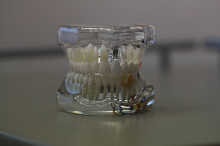 Dental Implant Healing Timeline