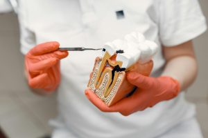 Dentist holding a tooth model explaining tooth sensitivity causes.
