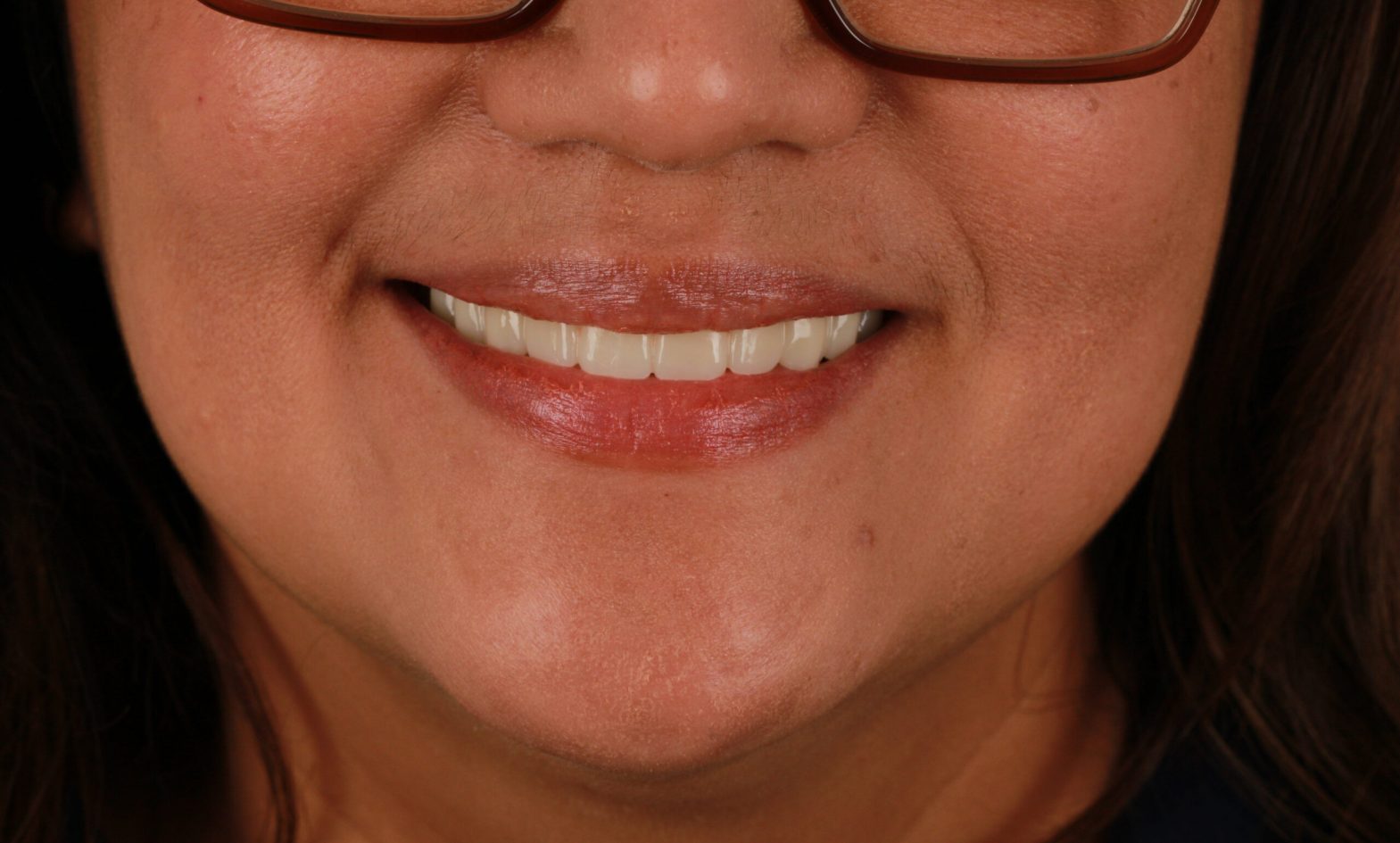 After All-on-4 dental implants