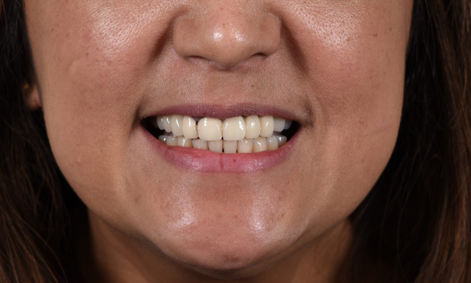Before All-on-4 dental implants