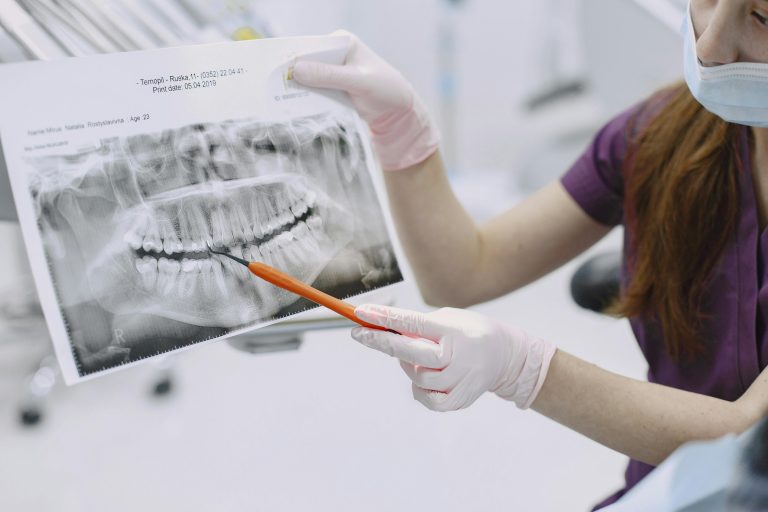 Tooth Decay Stages Explained