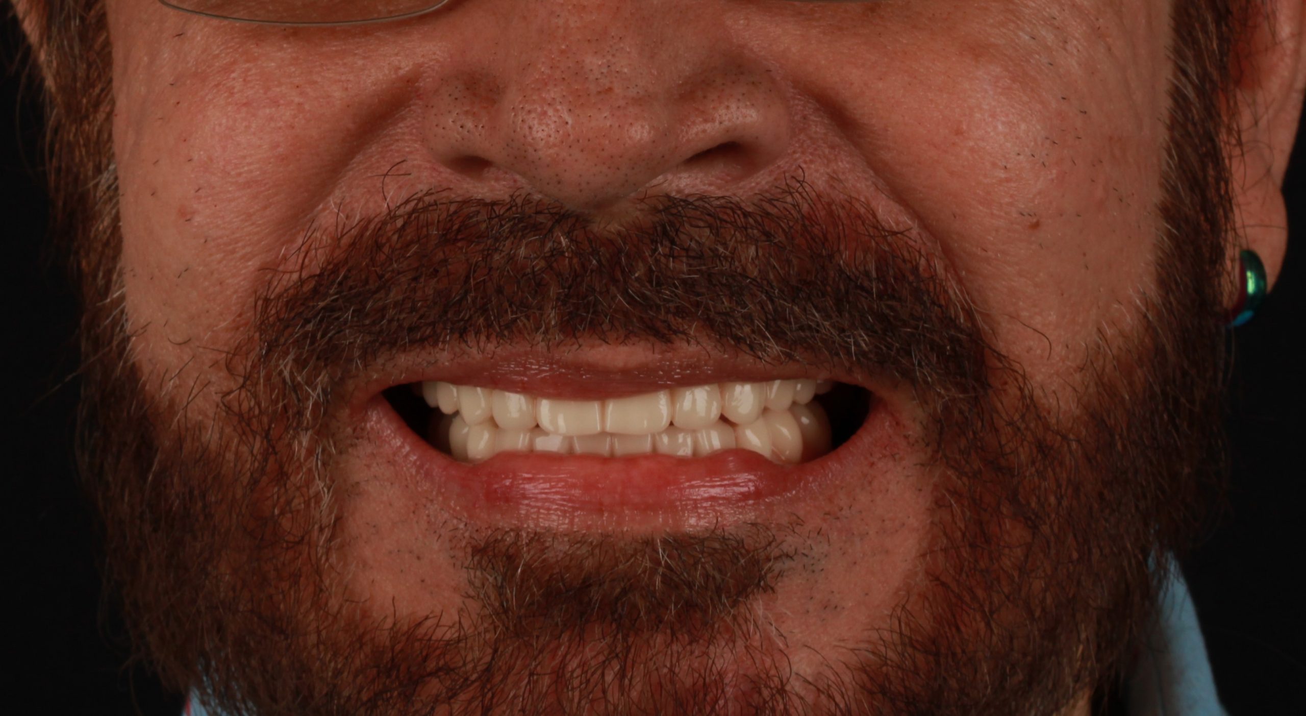 Patient after full arch implant restoration