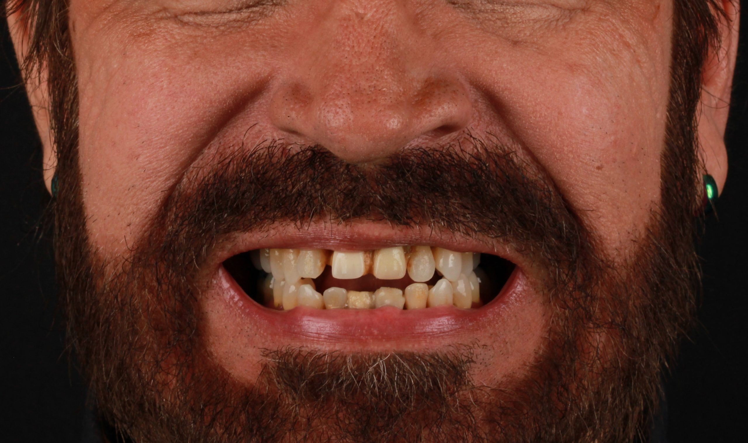 Patient before full arch implant restoration